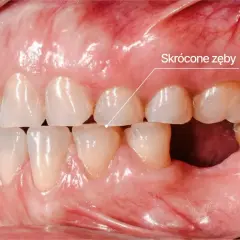 Zęby skrócone przez bruksizm. Widoczne starte siekacze i brak zębów trzonowych.