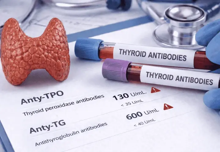 Model tarczycy, probówki z "THYROID ANTIBODIES" i wyniki badań, wskazujące na podwyższone poziomy anty-TPO i anty-TG.