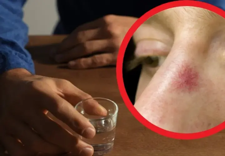 Dłoń sięga po kieliszek, a na policzku widoczne pajączki – objawy długotrwałego alkoholizmu.