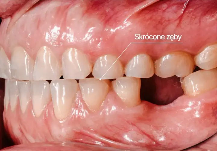 Zęby skrócone przez bruksizm. Widoczne starte siekacze i brak zębów trzonowych.