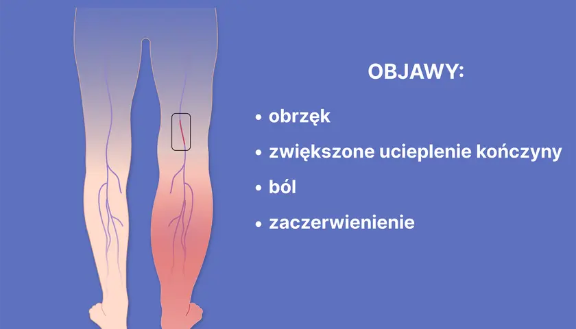 Objawy zaburzeń krzepnięcia krwi: Krwotok czy zakrzep? Sprawdź!